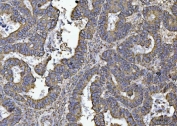 IHC staining of FFPE human ovarian cancer with ATP5F1B antibody. HIER: boil tissue sections in pH6, 10mM citrate buffer, for 20 min and allow to cool before testing.