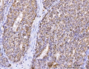 IHC staining of FFPE human breast cancer with ATP5F1B antibody. HIER: boil tissue sections in pH6, 10mM citrate buffer, for 20 min and allow to cool before testing.