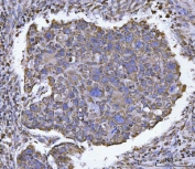 IHC staining of FFPE human esophageal squamous carcinoma tissue with ATP5F1B antibody. HIER: boil tissue sections in pH6, 10mM citrate buffer, for 20 min and allow to cool before testing.