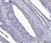 IHC staining of FFPE human endometrial adenocarcinoma tissue with ATP5F1B antibody. HIER: boil tissue sections in pH6, 10mM citrate buffer, for 20 min and allow to cool before testing.