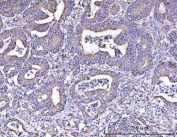 IHC staining of FFPE human rectal cancer tissue with ATP5F1B antibody. HIER: boil tissue sections in pH6, 10mM citrate buffer, for 20 min and allow to cool before testing.