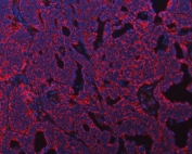 Immunofluorescent staining of FFPE human ovarian cancer tissue with ATP5F1B antibody (red) and DAPI nuclear stain (blue). HIER: steam section in pH8 EDTA for 20 min.