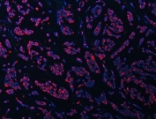 Immunofluorescent staining of FFPE human breast cancer tissue with ATP5F1B antibody (red) and DAPI nuclear stain (blue). HIER: steam section in pH8 EDTA for 20 min.