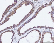 IHC staining of FFPE human colonic adenocarcinoma tissue with Carbonic Anhydrase IX antibody. HIER: boil tissue sections in pH8 EDTA for 20 min and allow to cool before testing.