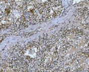IHC staining of FFPE human renal adenocarcinoma tissue with Carbonic Anhydrase IX antibody. HIER: boil tissue sections in pH8 EDTA for 20 min and allow to cool before testing.