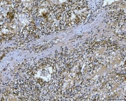 IHC staining of FFPE human renal adenocarcinoma tissue with Carbonic Anhydrase IX antibody. HIER: boil tissue sections in pH8 EDTA for 20 min and allow to cool before testing.