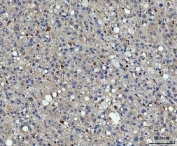 IHC staining of FFPE human liver cancer tissue with CD74 antibody. HIER: boil tissue sections in pH8 EDTA for 20 min and allow to cool before testing.