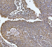 IHC staining of FFPE human esophageal squamous carcinoma tissue with COX5B antibody. HIER: boil tissue sections in pH8 EDTA for 20 min and allow to cool before testing.