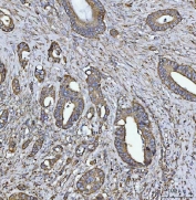 IHC staining of FFPE human colorectal adenocarcinoma tissue with COX5B antibody. HIER: boil tissue sections in pH8 EDTA for 20 min and allow to cool before testing.
