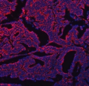 Immunofluorescent staining of FFPE human ovarian cancer tissue with COX5B antibody (red) and DAPI nuclear stain (blue). HIER: steam section in pH8 EDTA buffer for 20 min.