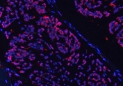 Immunofluorescent staining of FFPE human breast cancer tissue with COX5B antibody (red) and DAPI nuclear stain (blue). HIER: steam section in pH8 EDTA buffer for 20 min.