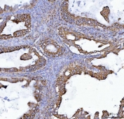 IHC staining of FFPE human ovarian cancer tissue with COX5B antibody. HIER: boil tissue sections in pH8 EDTA for 20 min and allow to cool before testing.