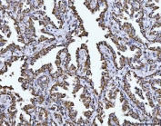 IHC staining of FFPE human lung cancer tissue with COX5B antibody. HIER: boil tissue sections in pH8 EDTA for 20 min and allow to cool before testing.