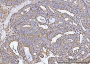IHC staining of FFPE human endometrial carcinoma tissue with COX5B antibody. HIER: boil tissue sections in pH8 EDTA for 20 min and allow to cool before testing.
