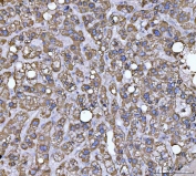 IHC staining of FFPE human liver cancer tissue with ECHS1 antibody. HIER: boil tissue sections in pH8 EDTA for 20 min and allow to cool before testing.
