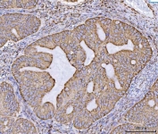 IHC staining of FFPE human ovarian cancer tissue with ECHS1 antibody. HIER: boil tissue sections in pH8 EDTA for 20 min and allow to cool before testing.