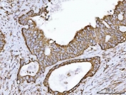 IHC staining of FFPE human colorectal adenocarcinoma tissue with ECHS1 antibody. HIER: boil tissue sections in pH8 EDTA for 20 min and allow to cool before testing.