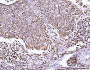 IHC staining of FFPE human esophageal squamous carcinoma tissue with ECHS1 antibody. HIER: boil tissue sections in pH8 EDTA for 20 min and allow to cool before testing.