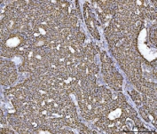 IHC staining of FFPE human breast cancer tissue with ECHS1 antibody. HIER: boil tissue sections in pH8 EDTA for 20 min and allow to cool before testing.