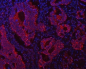 Immunofluorescent staining of FFPE human intestinal cancer tissue with ECHS1 antibody (red) and DAPI nuclear stain (blue). HIER: steam section in pH8 EDTA buffer for 20 min.