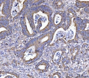 IHC staining of FFPE human colorectal adenocarcinoma tissue with EIF3A antibody. HIER: boil tissue sections in pH8 EDTA for 20 min and allow to cool before testing.