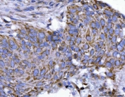 IHC staining of FFPE human esophageal squamous carcinoma tissue with EIF3A antibody. HIER: boil tissue sections in pH8 EDTA for 20 min and allow to cool before testing.