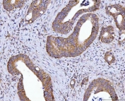 IHC staining of FFPE human colorectal adenocarcinoma tissue with HAX1 antibody. HIER: boil tissue sections in pH8 EDTA for 20 min and allow to cool before testing.