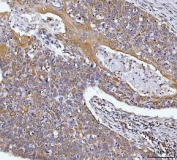 IHC staining of FFPE human esophageal squamous carcinoma tissue with HAX1 antibody. HIER: boil tissue sections in pH8 EDTA for 20 min and allow to cool before testing.