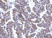 IHC staining of FFPE human lung cancer tissue with HAX1 antibody. HIER: boil tissue sections in pH8 EDTA for 20 min and allow to cool before testing.