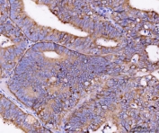 IHC staining of FFPE human endometrial adenocarcinoma tissue with Eg5 antibody. HIER: boil tissue sections in pH8 EDTA for 20 min and allow to cool before testing.