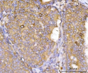 IHC staining of FFPE human breast cancer tissue with Eg5 antibody. HIER: boil tissue sections in pH8 EDTA for 20 min and allow to cool before testing.