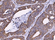 IHC staining of FFPE human colorectal adenocarcinoma tissue with MRPS18B antibody. HIER: boil tissue sections in pH8 EDTA for 20 min and allow to cool before testing.