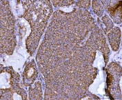 IHC staining of FFPE human breast cancer tissue with NDUFS2 antibody. HIER: boil tissue sections in pH8 EDTA for 20 min and allow to cool before testing.