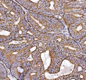 IHC staining of FFPE human endometrial adenocarcinoma tissue with NDUFS2 antibody. HIER: boil tissue sections in pH8 EDTA for 20 min and allow to cool before testing.