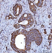 IHC staining of FFPE human colorectal adenocarcinoma tissue with NDUFS2 antibody. HIER: boil tissue sections in pH8 EDTA for 20 min and allow to cool before testing.