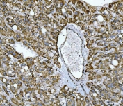 IHC staining of FFPE human liver cancer tissue with NDUFS2 antibody. HIER: boil tissue sections in pH8 EDTA for 20 min and allow to cool before testing.