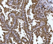 IHC staining of FFPE human lung cancer tissue with NDUFS2 antibody. HIER: boil tissue sections in pH8 EDTA for 20 min and allow to cool before testing.