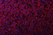 Immunofluorescent staining of FFPE human liver cancer tissue with NDUFS2 antibody (red) and DAPI nuclear stain (blue). HIER: steam section in pH8 EDTA buffer for 20 min.