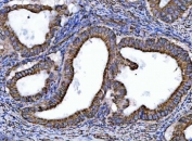 IHC staining of FFPE human ovarian cancer tissue with NDUFS6 antibody. HIER: boil tissue sections in pH8 EDTA for 20 min and allow to cool before testing.