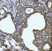 IHC staining of FFPE human breast cancer tissue with NDUFS6 antibody. HIER: boil tissue sections in pH8 EDTA for 20 min and allow to cool before testing.