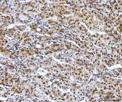 IHC staining of FFPE human liver cancer tissue with NDUFS8 antibody. HIER: boil tissue sections in pH8 EDTA for 20 min and allow to cool before testing.