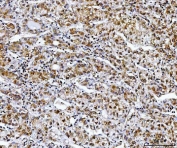 IHC staining of FFPE human liver cancer tissue with NDUFS8 antibody. HIER: boil tissue sections in pH8 EDTA for 20 min and allow to cool before testing.