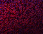 Immunofluorescent staining of FFPE human liver cancer tissue with NDUFS8 antibody (red) and DAPI nuclear stain (blue). HIER: steam section in pH8 EDTA buffer for 20 min.