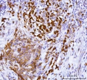 IHC staining of FFPE human cervical cancer tissue with APP-1 antibody. HIER: boil tissue sections in pH8 EDTA for 20 min and allow to cool before testing.