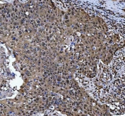 IHC staining of FFPE human esophageal squamous carcinoma tissue with PSMB4 antibody. HIER: boil tissue sections in pH8 EDTA for 20 min and allow to cool before testing.