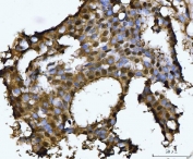 IHC staining of FFPE human breast cancer tissue with PSMB4 antibody. HIER: boil tissue sections in pH8 EDTA for 20 min and allow to cool before testing.