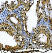 IHC staining of FFPE human ovarian cancer tissue with PSMB4 antibody. HIER: boil tissue sections in pH8 EDTA for 20 min and allow to cool before testing.