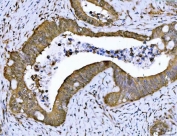 IHC staining of FFPE human colorectal adenocarcinoma tissue with PSMB4 antibody. HIER: boil tissue sections in pH8 EDTA for 20 min and allow to cool before testing.