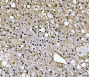 IHC staining of FFPE human liver cancer tissue with PSMB4 antibody. HIER: boil tissue sections in pH8 EDTA for 20 min and allow to cool before testing.