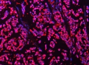Immunofluorescent staining of FFPE human breast cancer tissue with PSMB4 antibody (red) and DAPI nuclear stain (blue). HIER: steam section in pH8 EDTA buffer for 20 min.